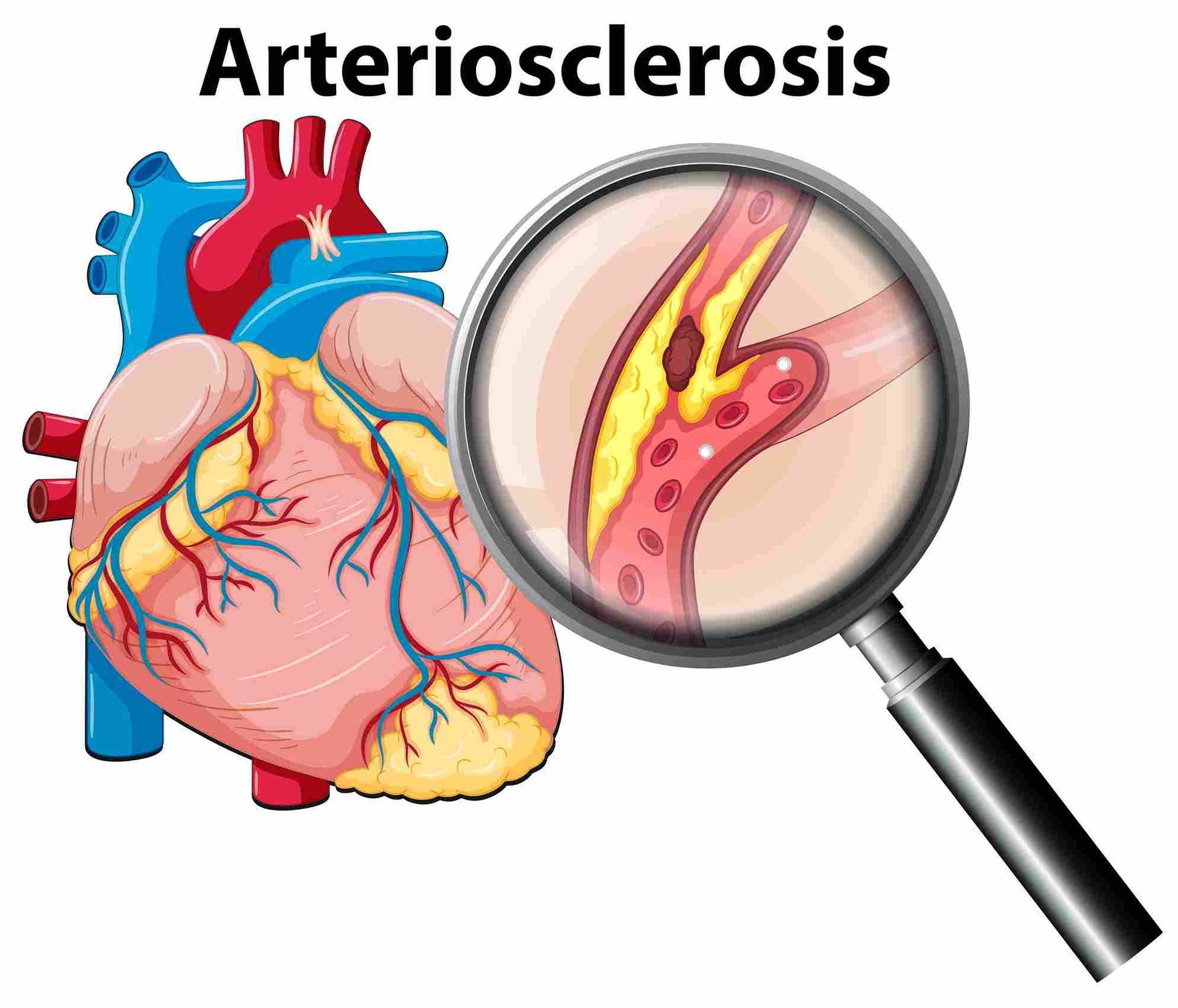 arteriosclerosis