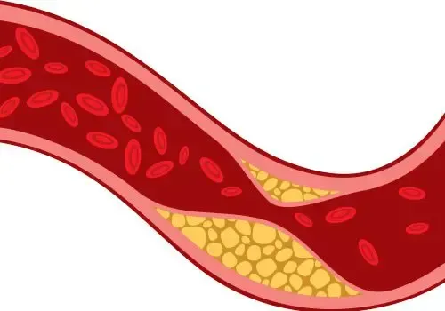 artery with cholesterol buildup