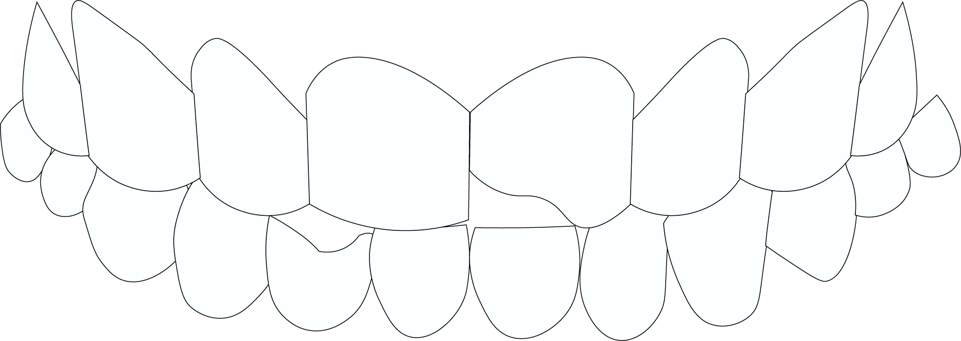 Chipped Teeth