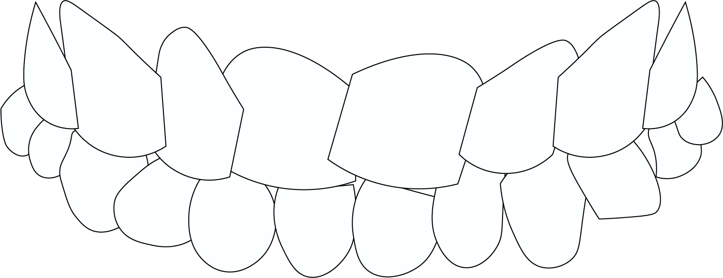 Invisalign Teeth Crowding