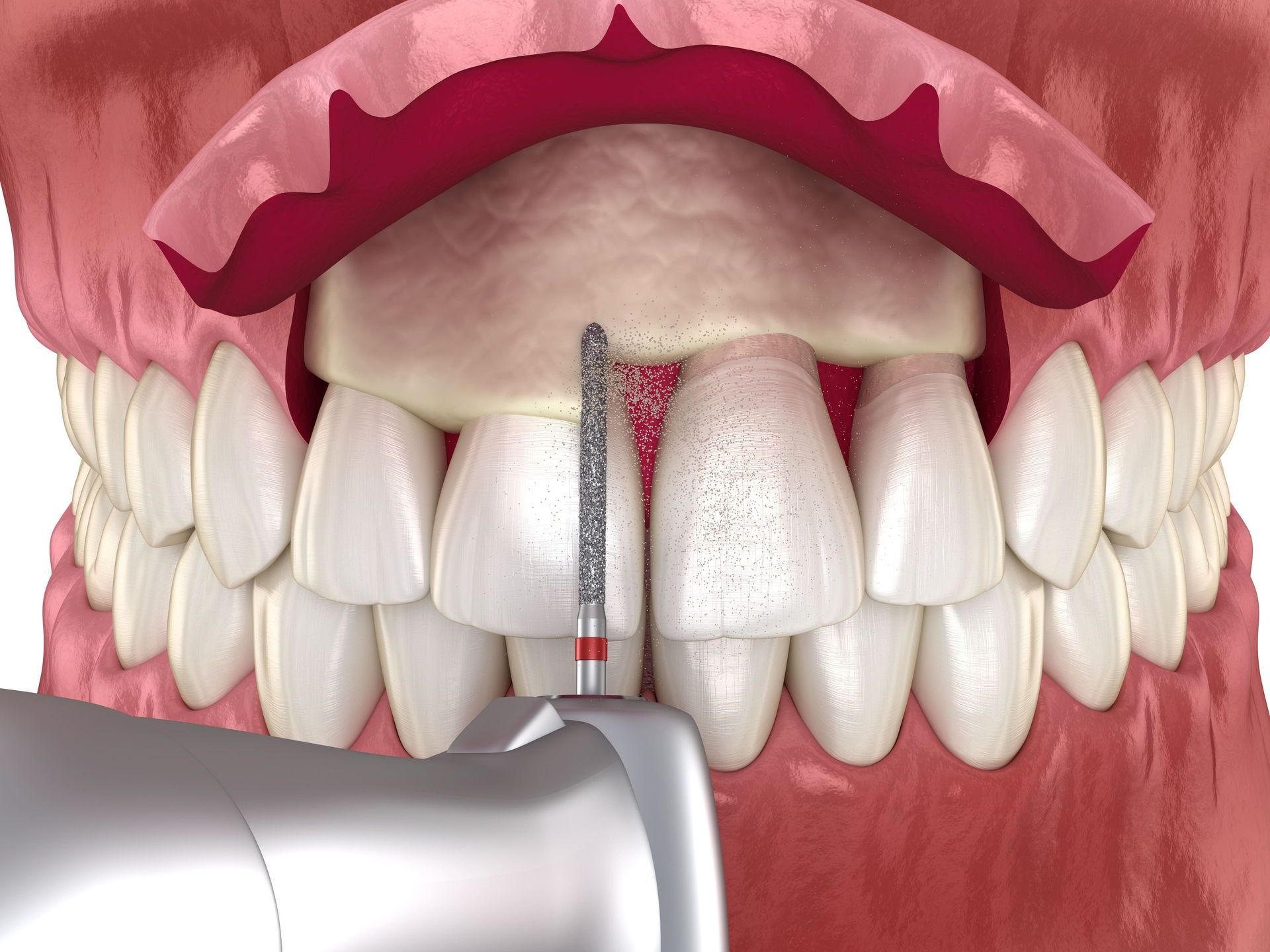 Crown Lengthening