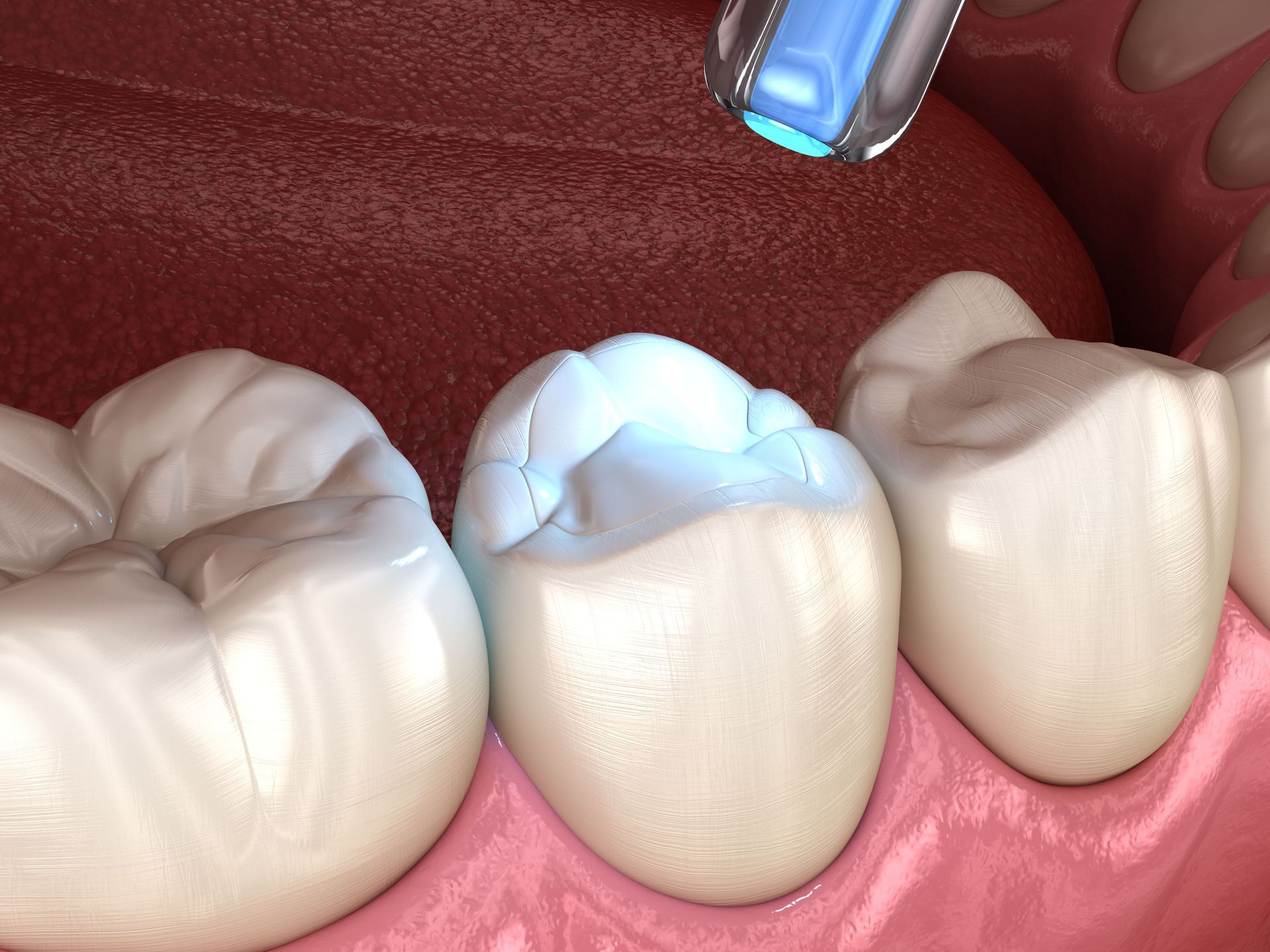 Teeth bonding