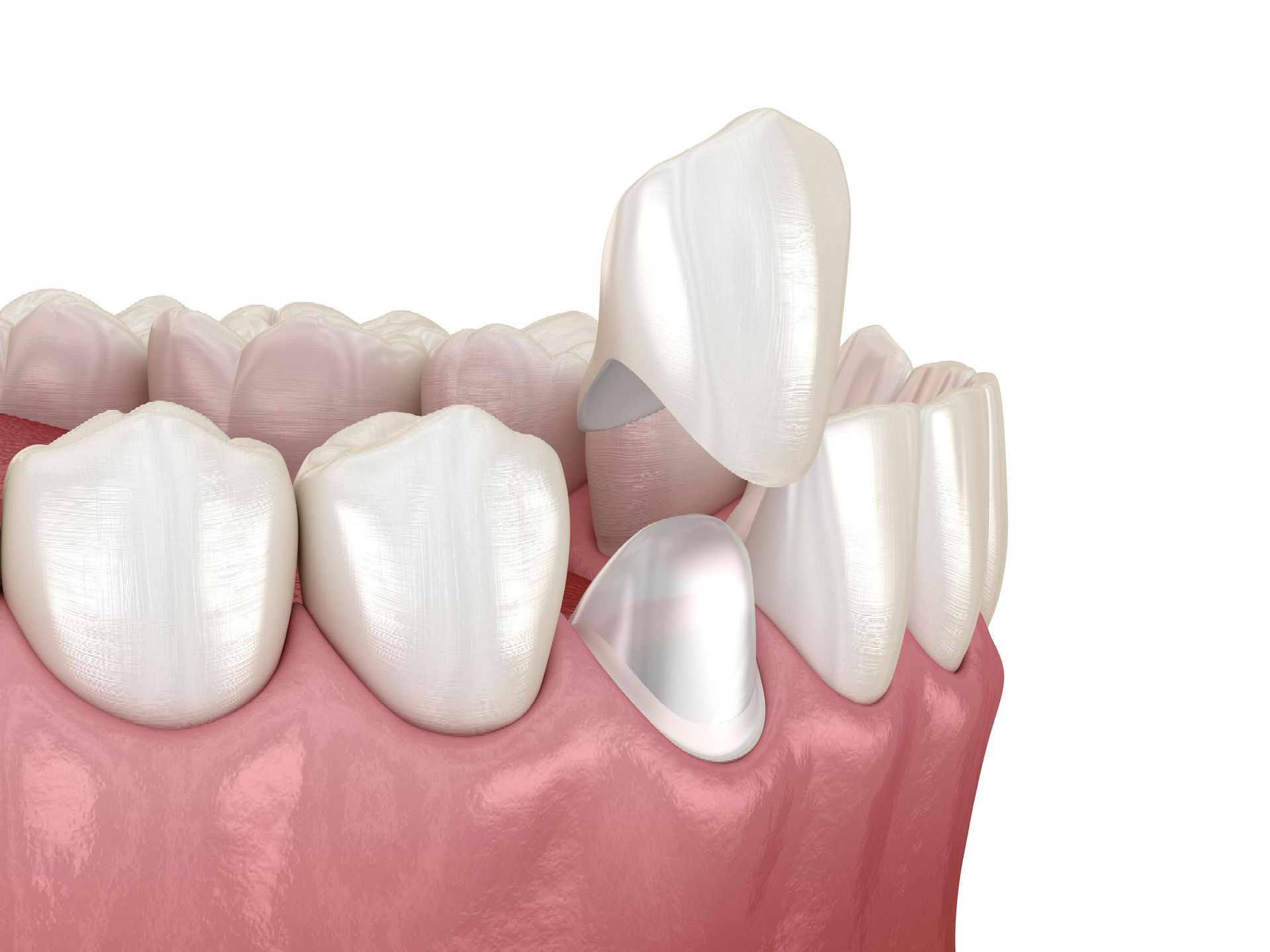 Dental Crowns