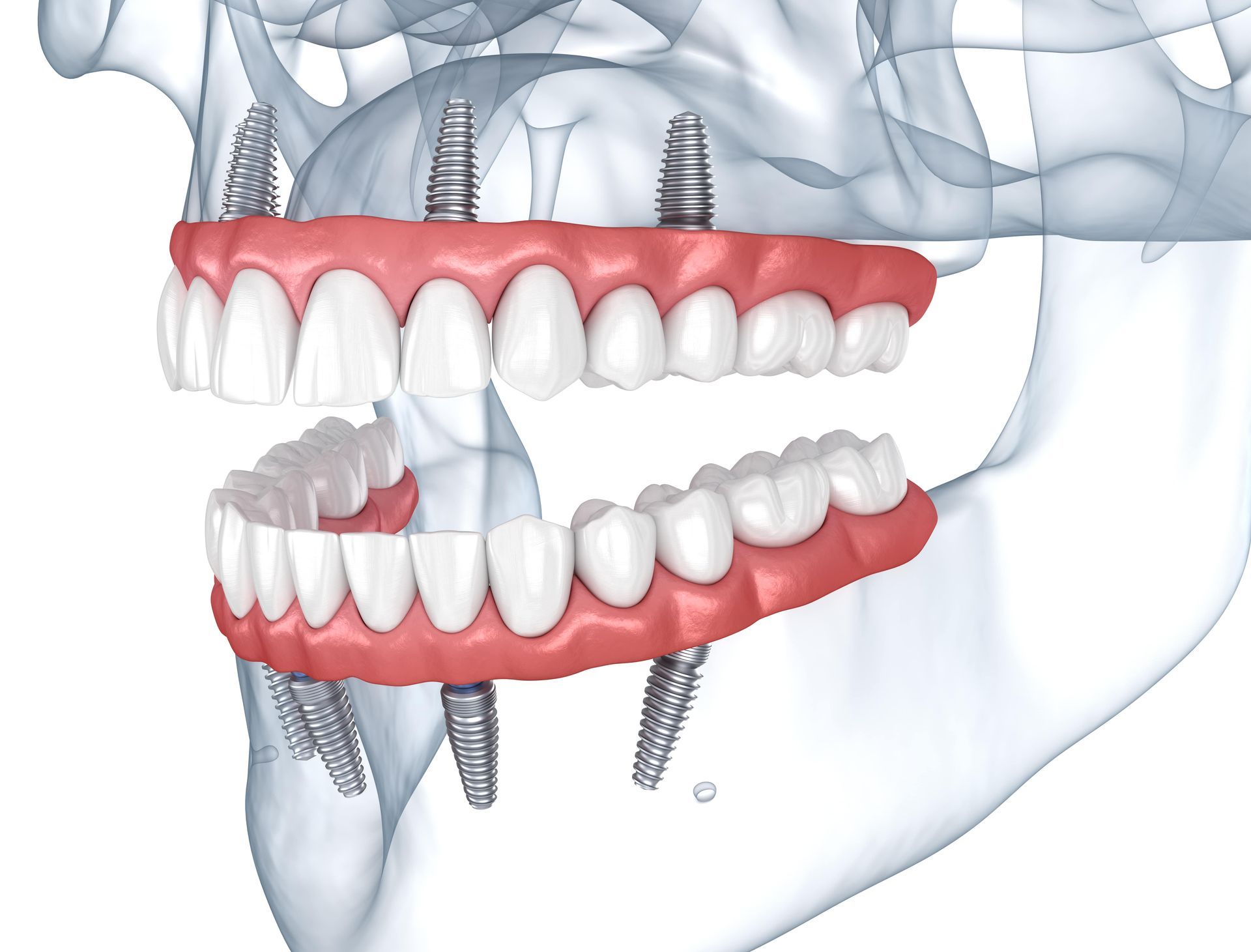 Dentures