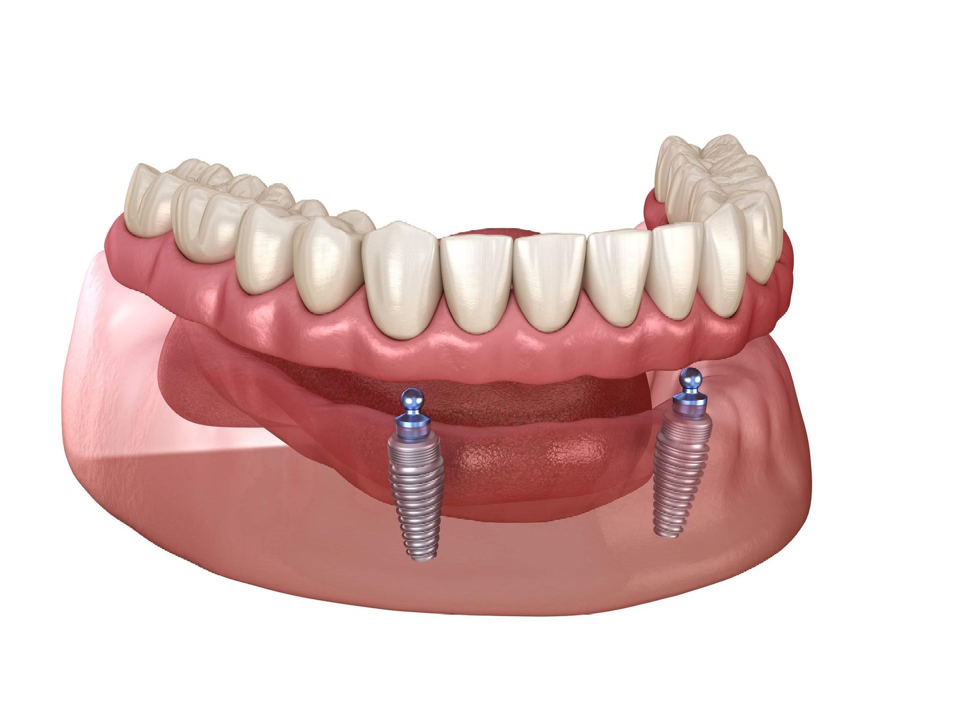 Implant-supported dentures