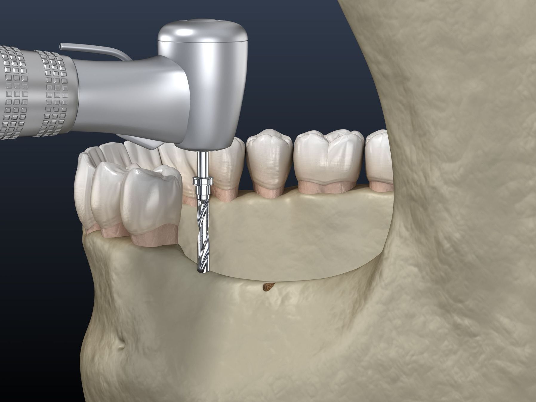 Ridge augmentation