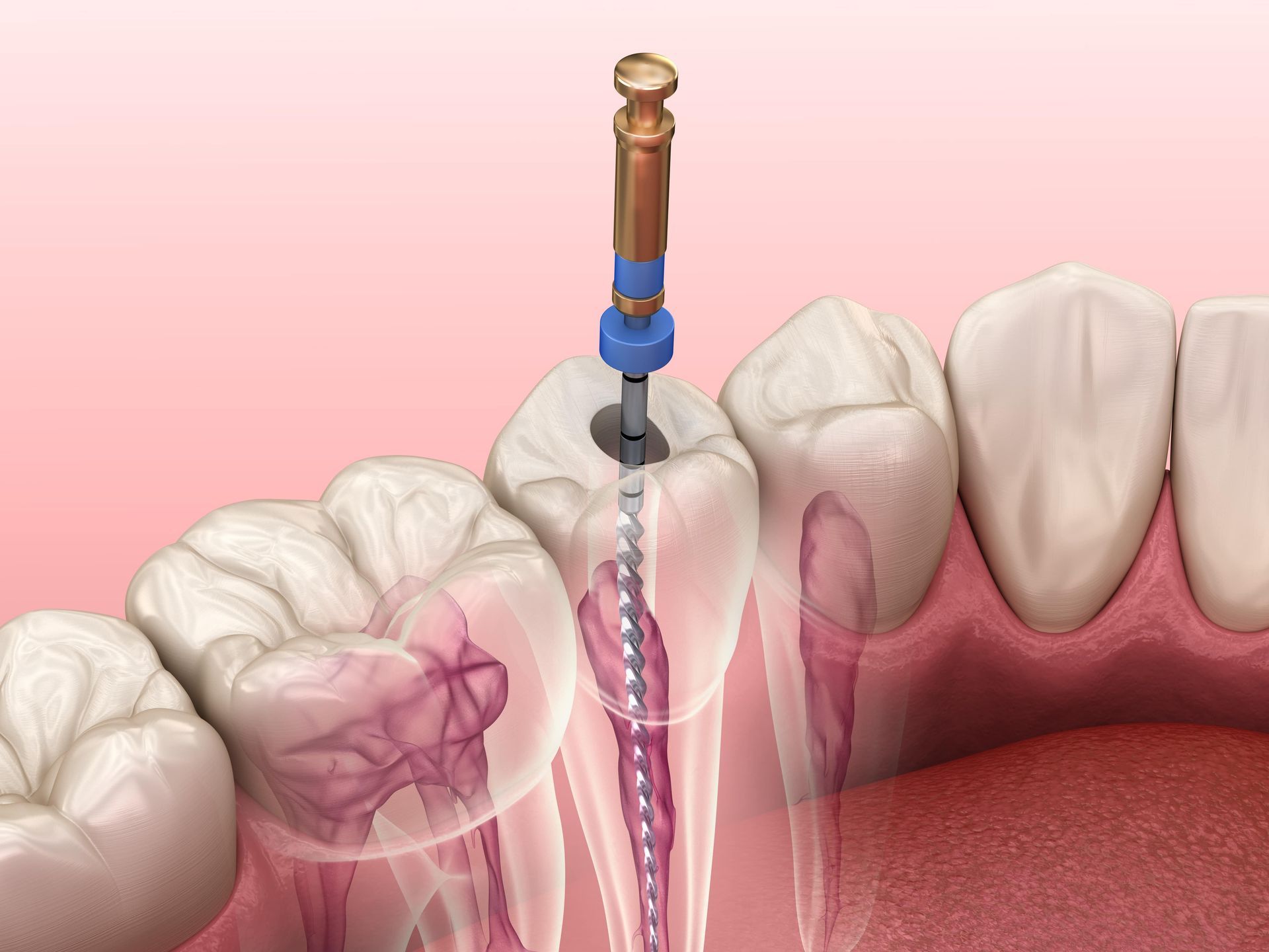 Root Canals