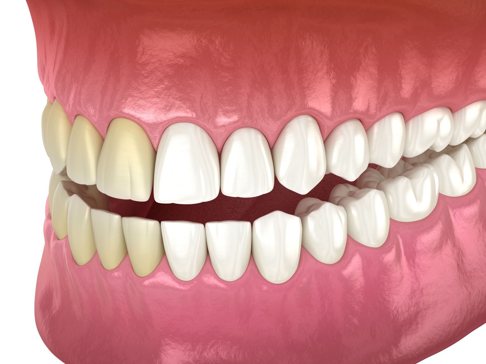 Teeth Whitening