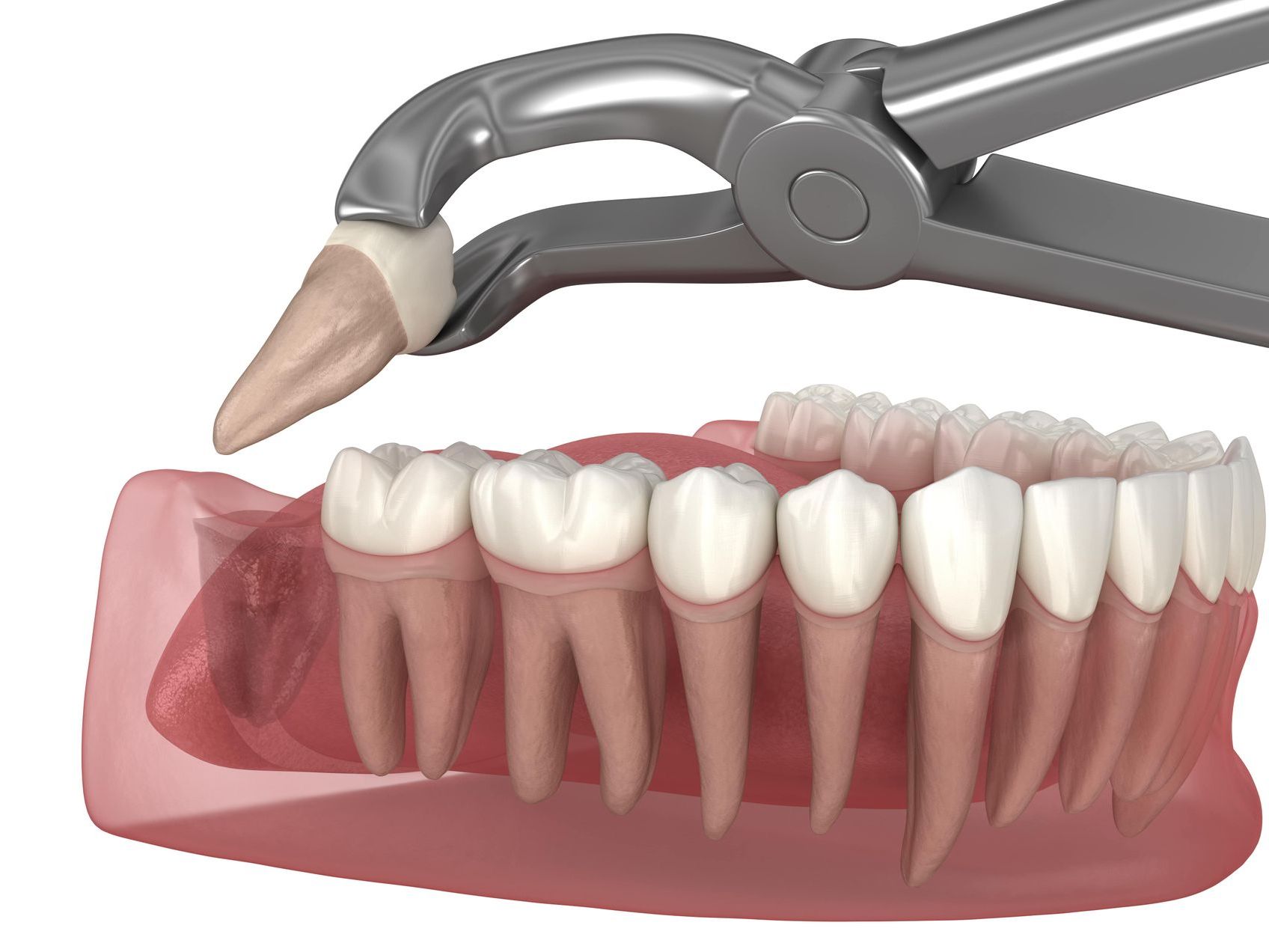 Wisdom tooth removal