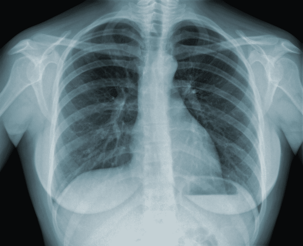 Um close de uma radiografia do tórax de uma pessoa.