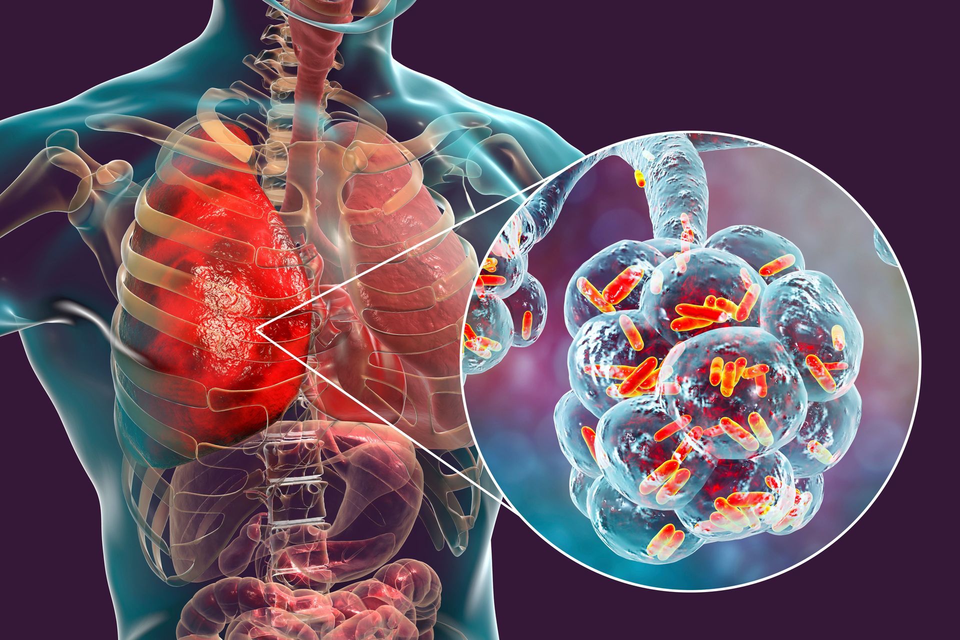 pneumonia bacteriana