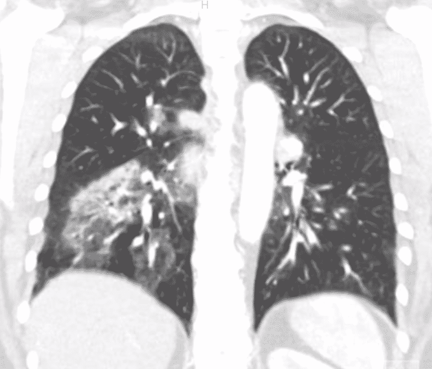 Uma imagem em preto e branco dos pulmões de uma pessoa.