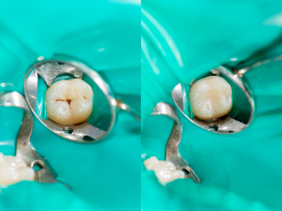 Dental Filling Before and After