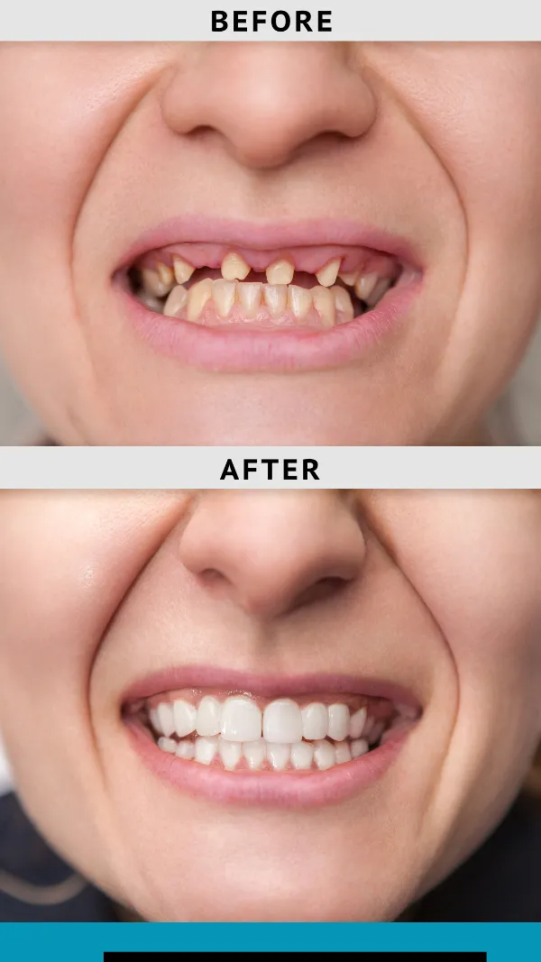 A before and after picture of a patient who received a dental implant