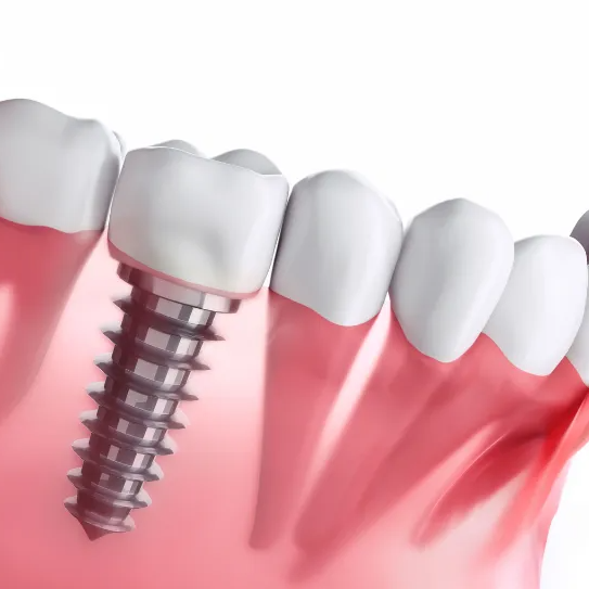 A close up of a dental implant