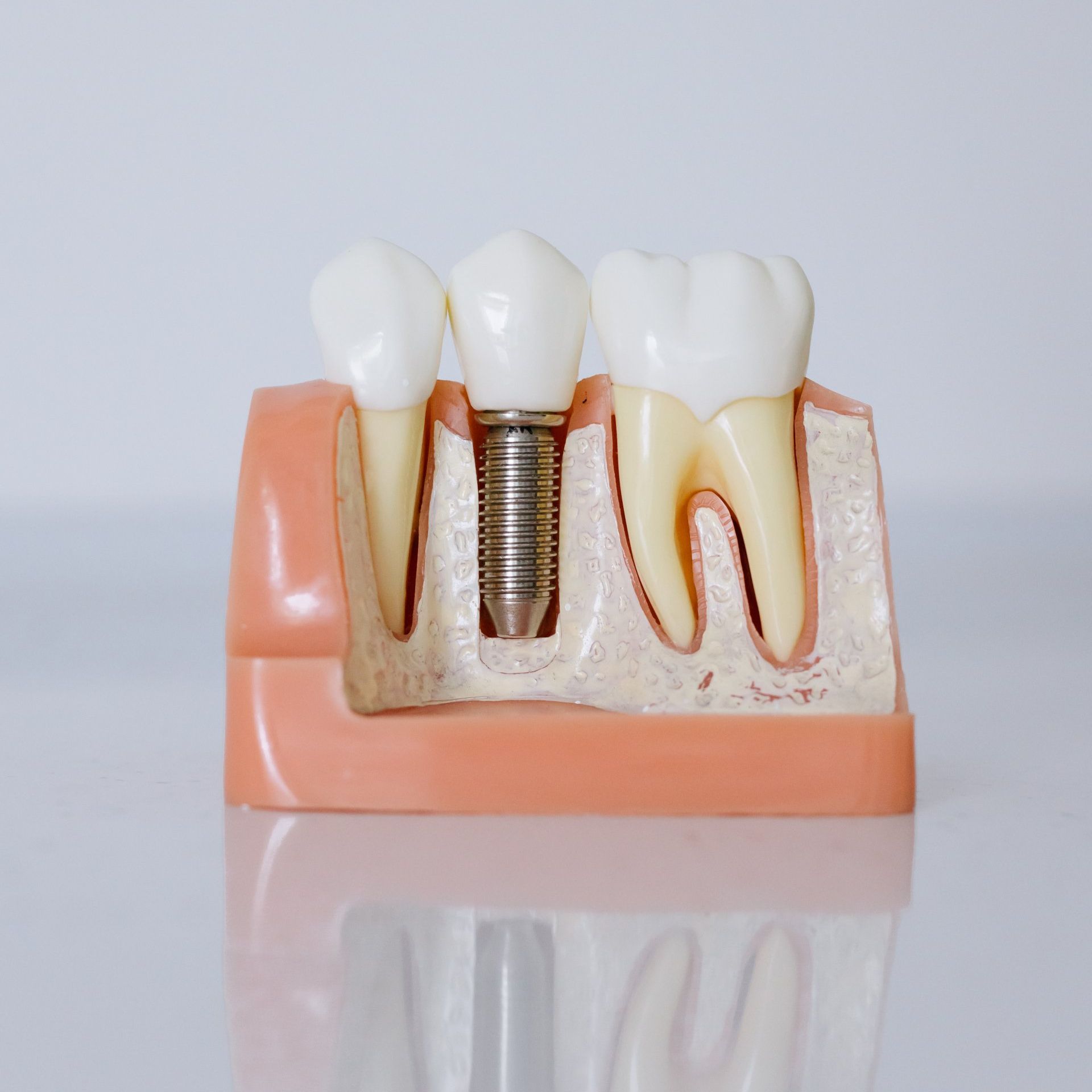 dental implants Michigan City