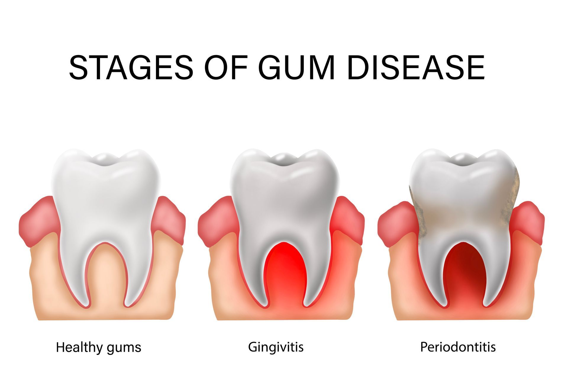 Healthy Gums