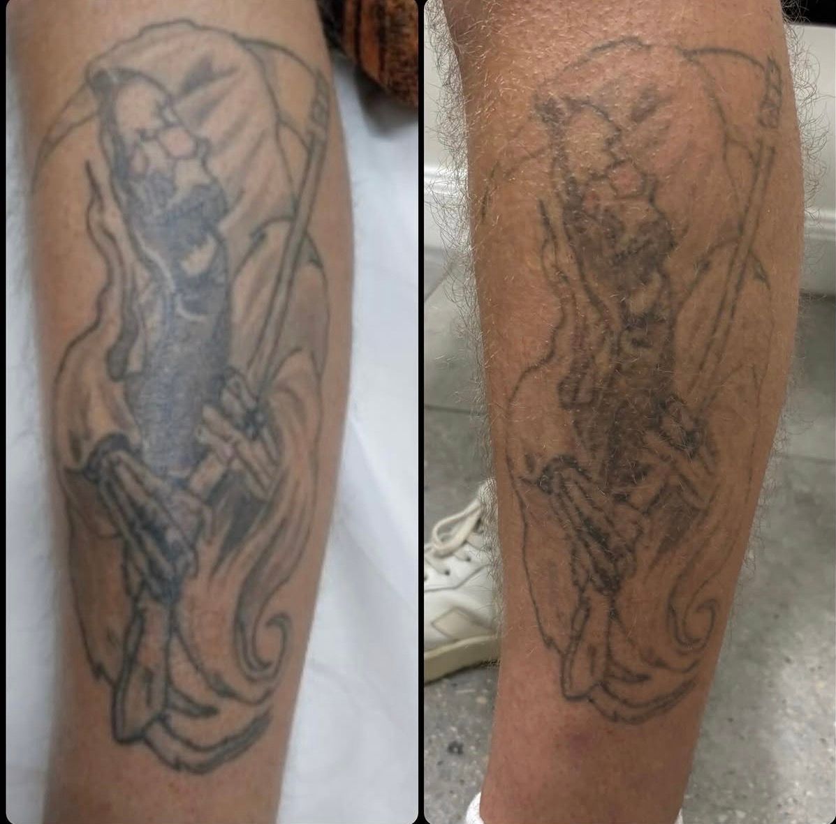 Side-by-side close-up of a faded black tattoo on a calf, showing before-and-after comparison. — Laserpro Tattoo Removal in Shellharbour, NSW