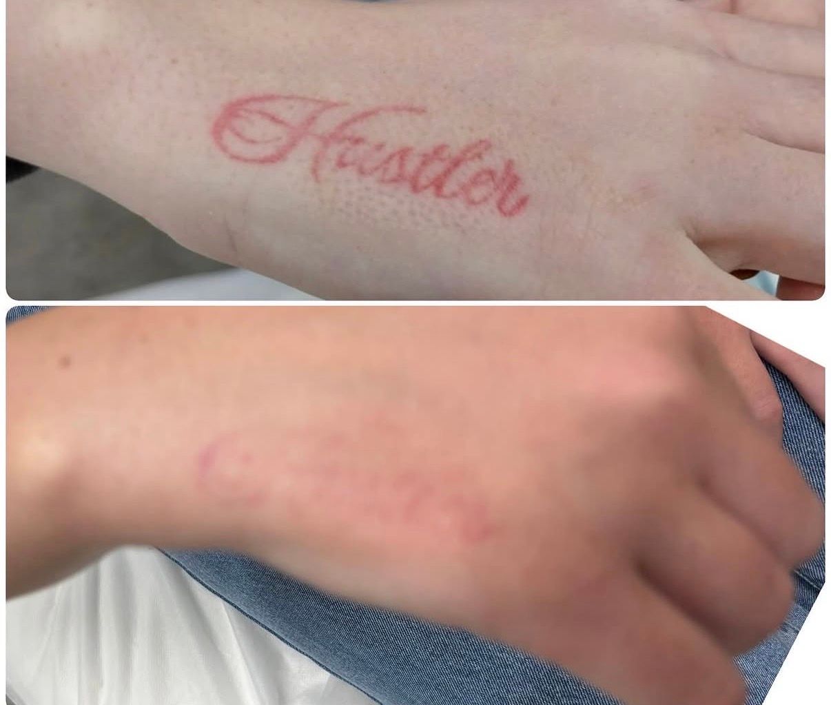 Two close-up photos of a hand, one showing red script writing and the other showing a faded pink mark on the skin. — Laserpro Tattoo Removal in Shellharbour, NSW