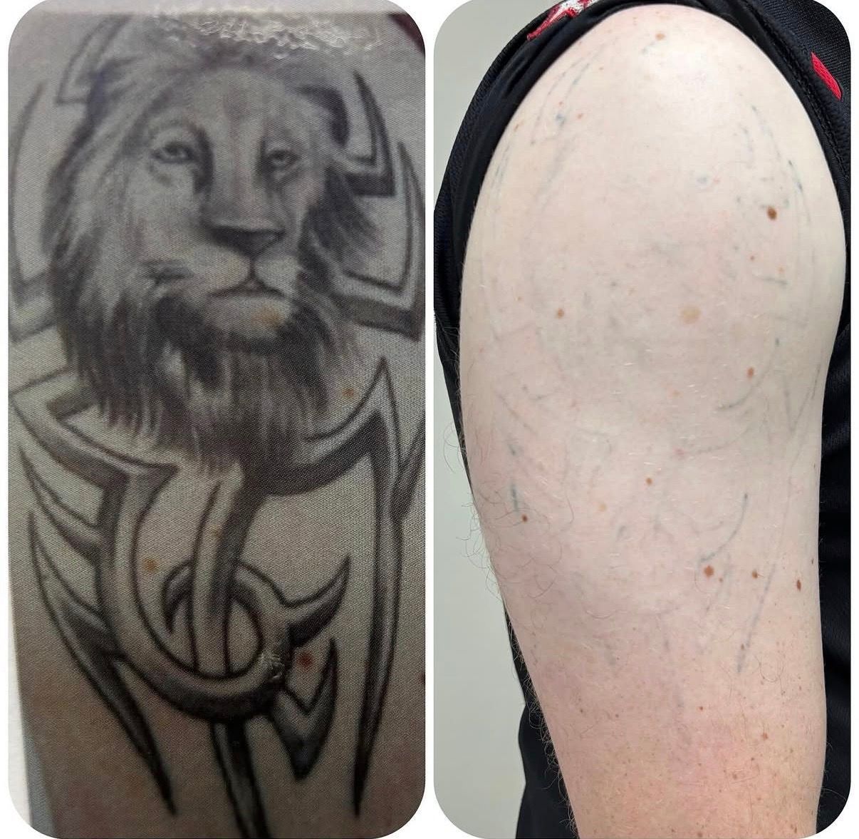Side-by-side tattoo comparison: lion chest tattoo on left, bare shoulder/back on right. — Laserpro Tattoo Removal in Shellharbour, NSW