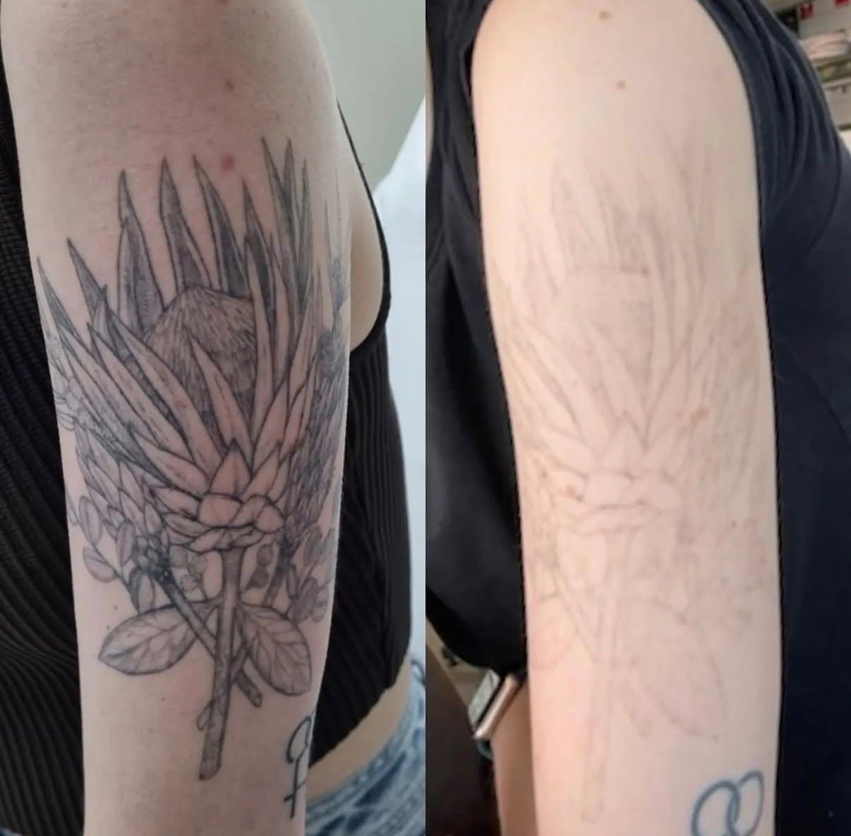 Tattooed Forearms and Hands — Laserpro Tattoo Removal in Shellharbour, NSW