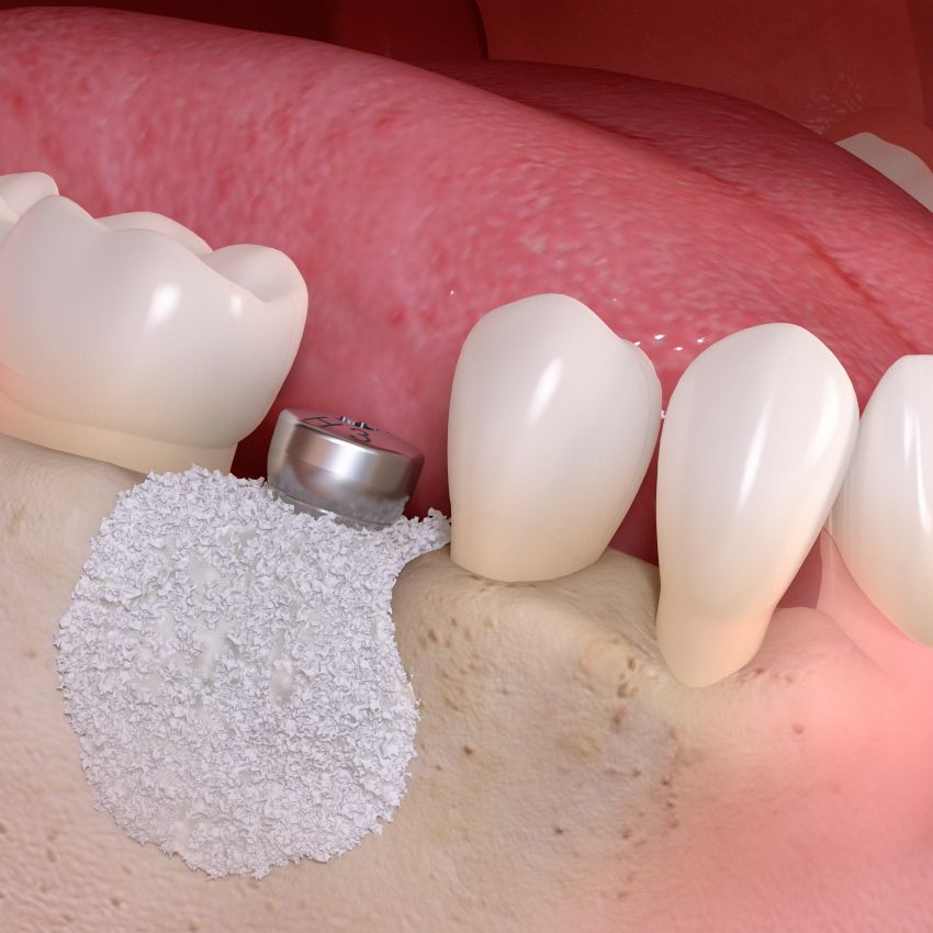 Un primo piano dei denti di una persona a cui manca un dente