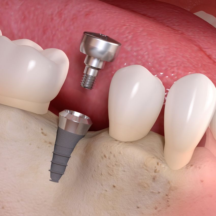 Un primo piano di un dente con una vite