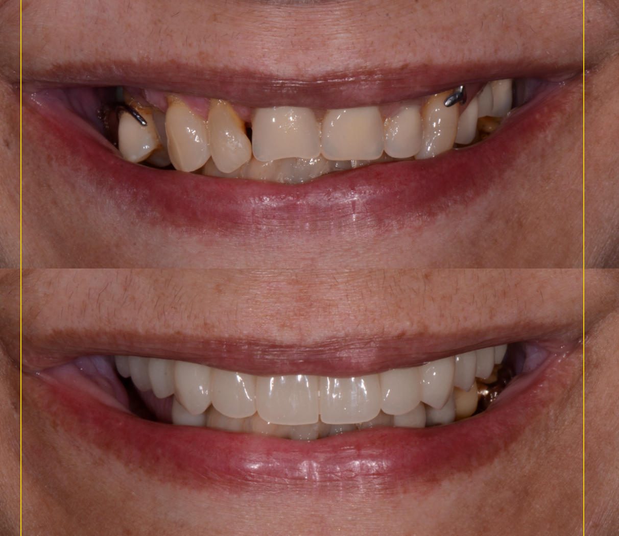 Una foto dei denti di una donna prima e dopo.