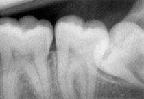 Una radiografia in bianco e nero dei denti di una persona.