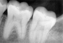 Una radiografia in bianco e nero dei denti di una persona.