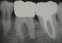 Una radiografia in bianco e nero di un dente con un buco.