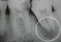 Una radiografia in bianco e nero di un dente con un cerchio attorno.
