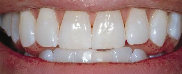 Un primo piano dei denti di una persona con denti bianchi.