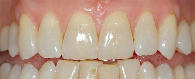 Un primo piano dei denti di una persona con denti bianchi.