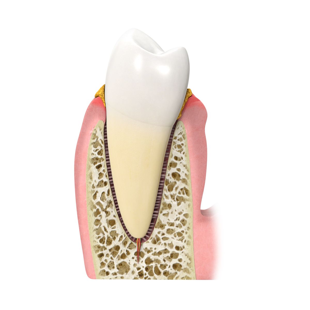 Primo piano di un dente con placca.