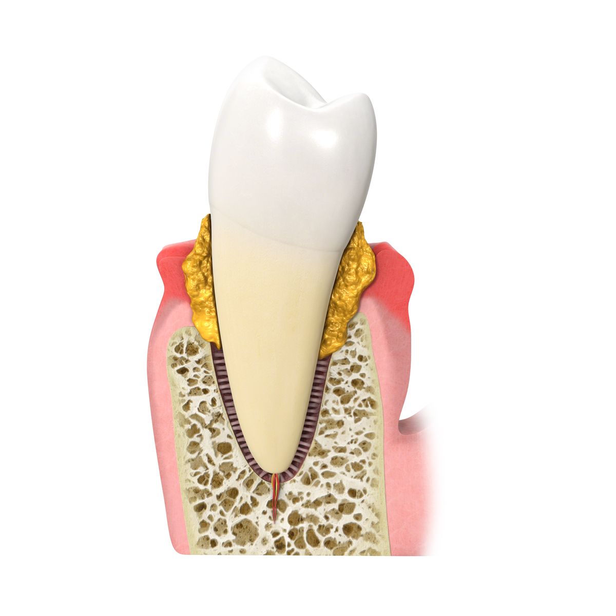 Un primo piano di un dente con placca sopra