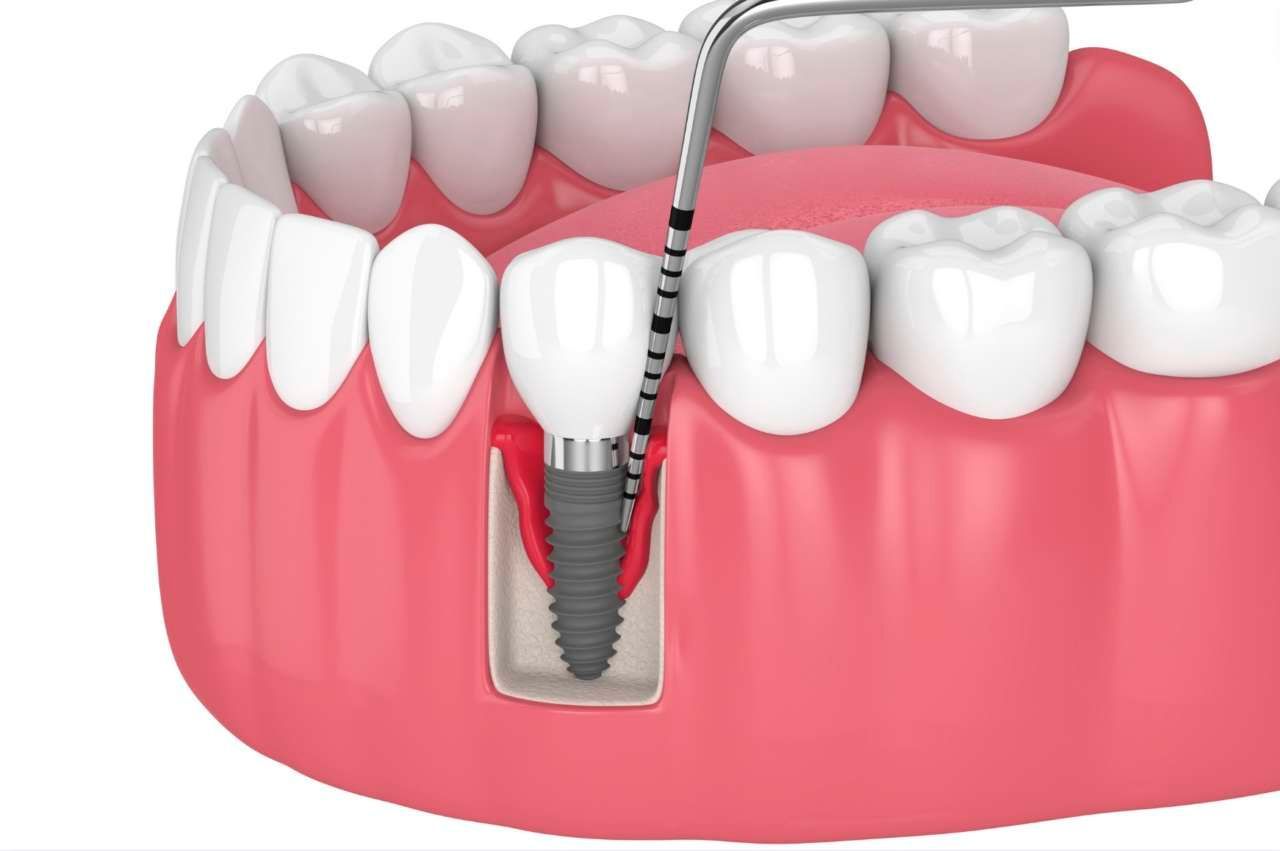 Un impianto dentale viene inserito in un dente.