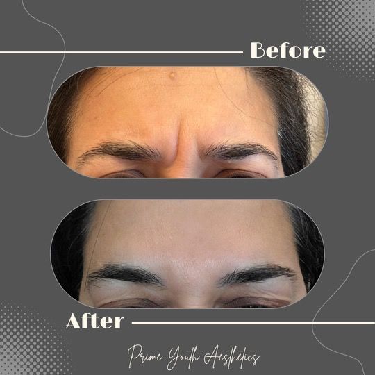 A before and after picture of a woman 's forehead
