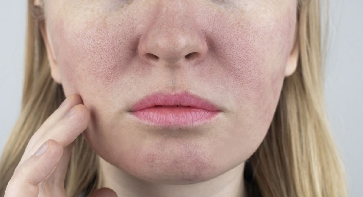 A close up of a woman 's face with red spots on it.