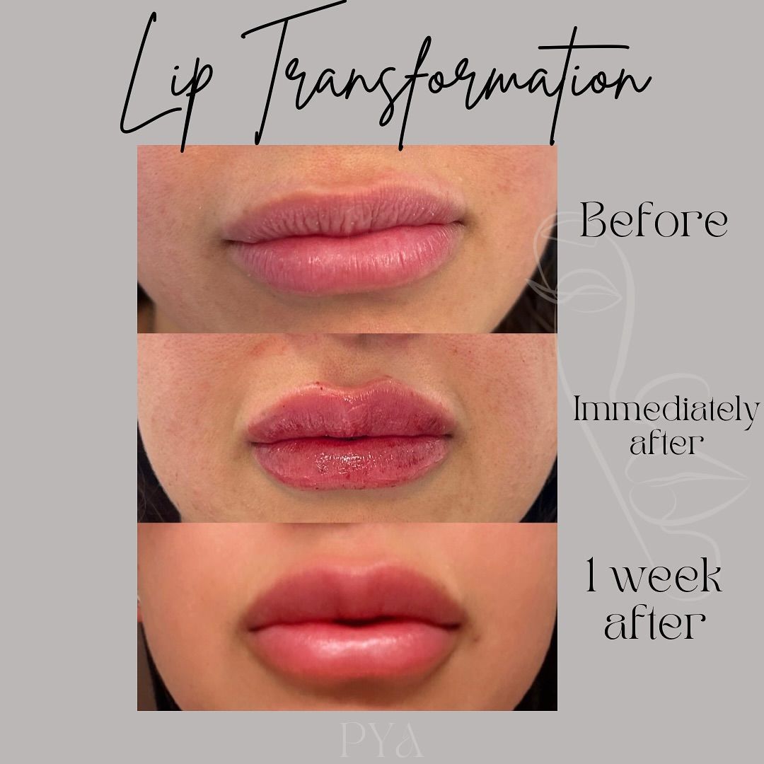 A picture of a woman 's lips before and after lip injections