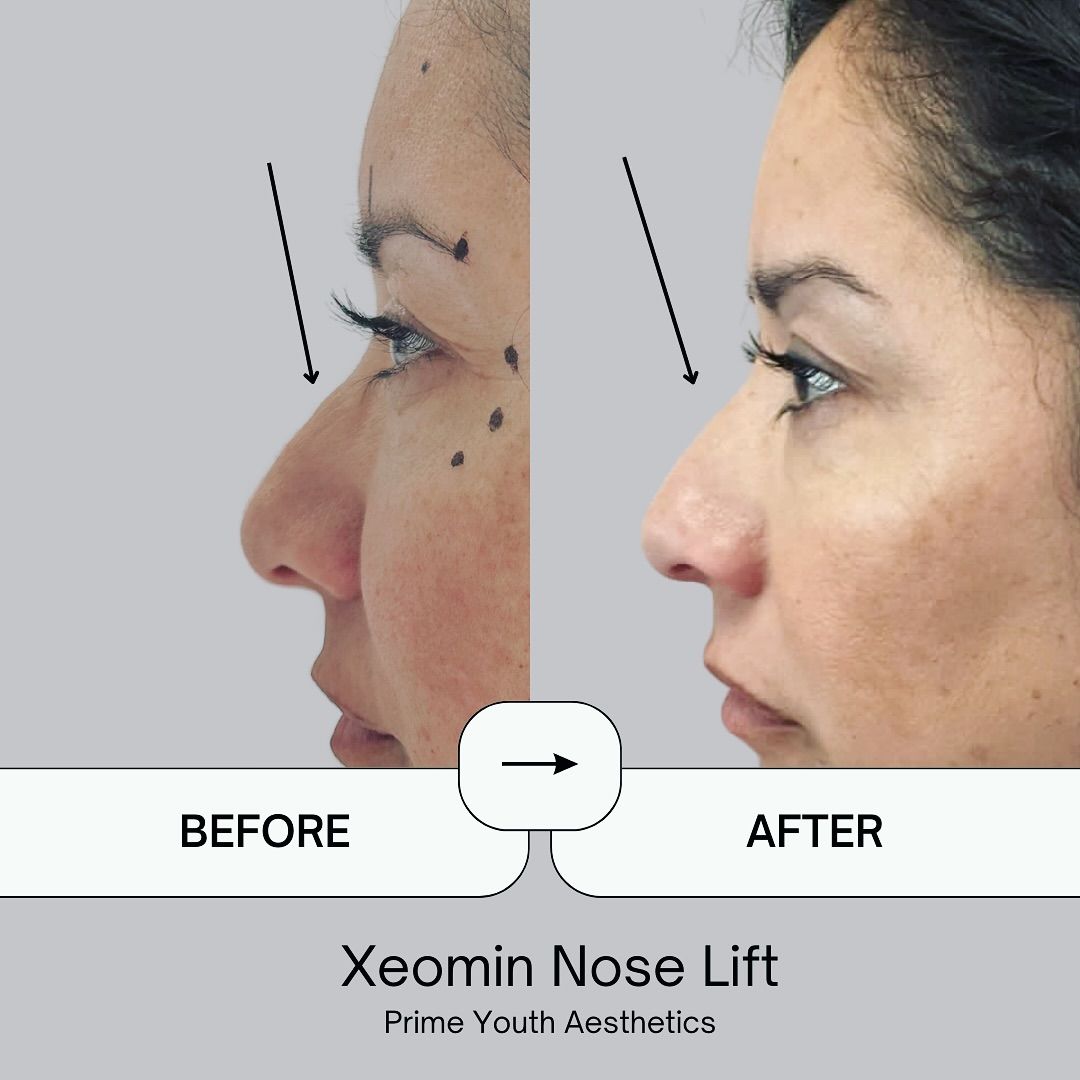 A before and after picture of a woman 's nose lift