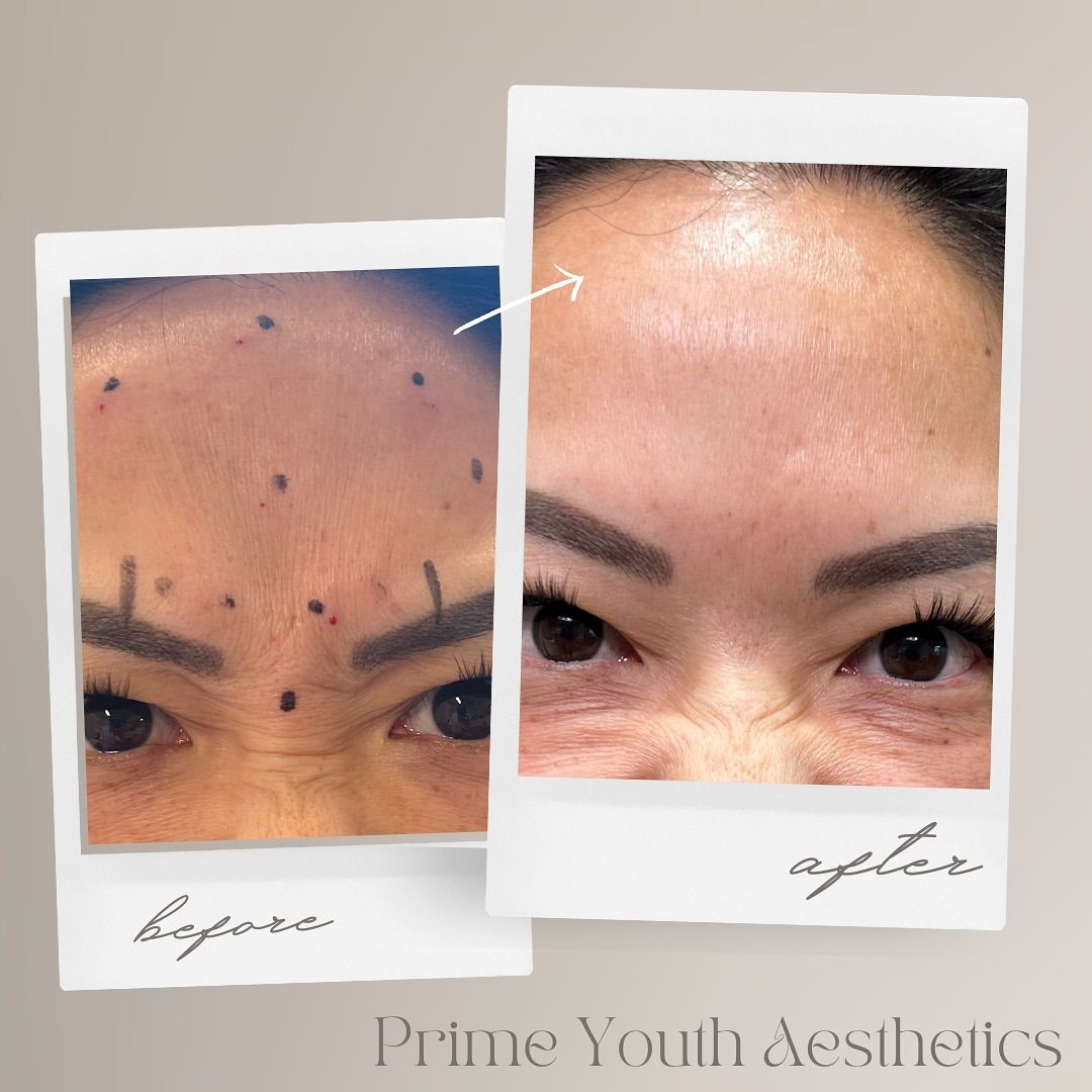 A before and after photo of a woman 's forehead.