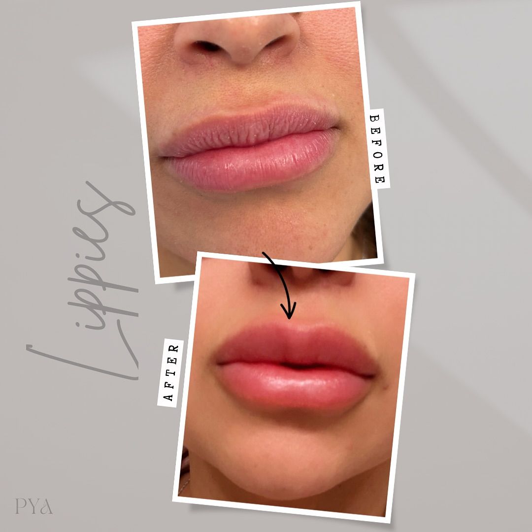 A picture of a woman 's lips before and after lip injections