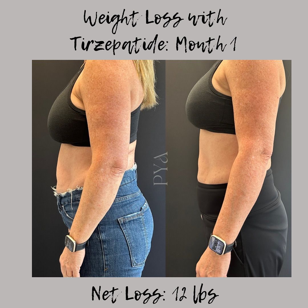 A before and after photo of a woman 's weight loss with turzepatide.