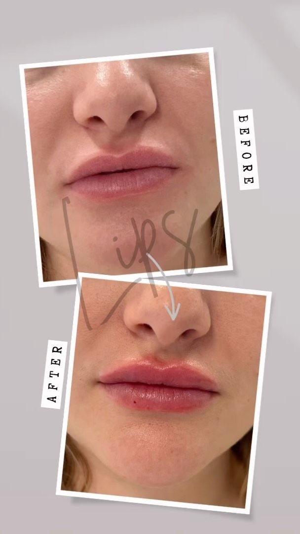 A before and after picture of a woman 's lips.