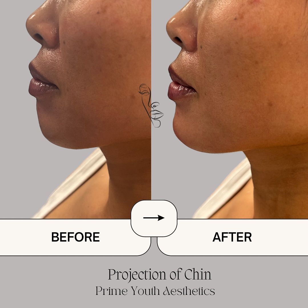 A before and after photo of a woman 's chin