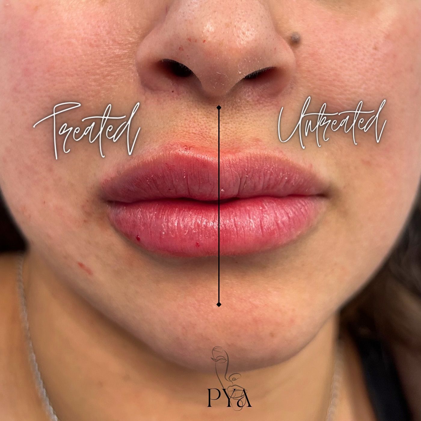 A before and after photo of a woman 's lips.