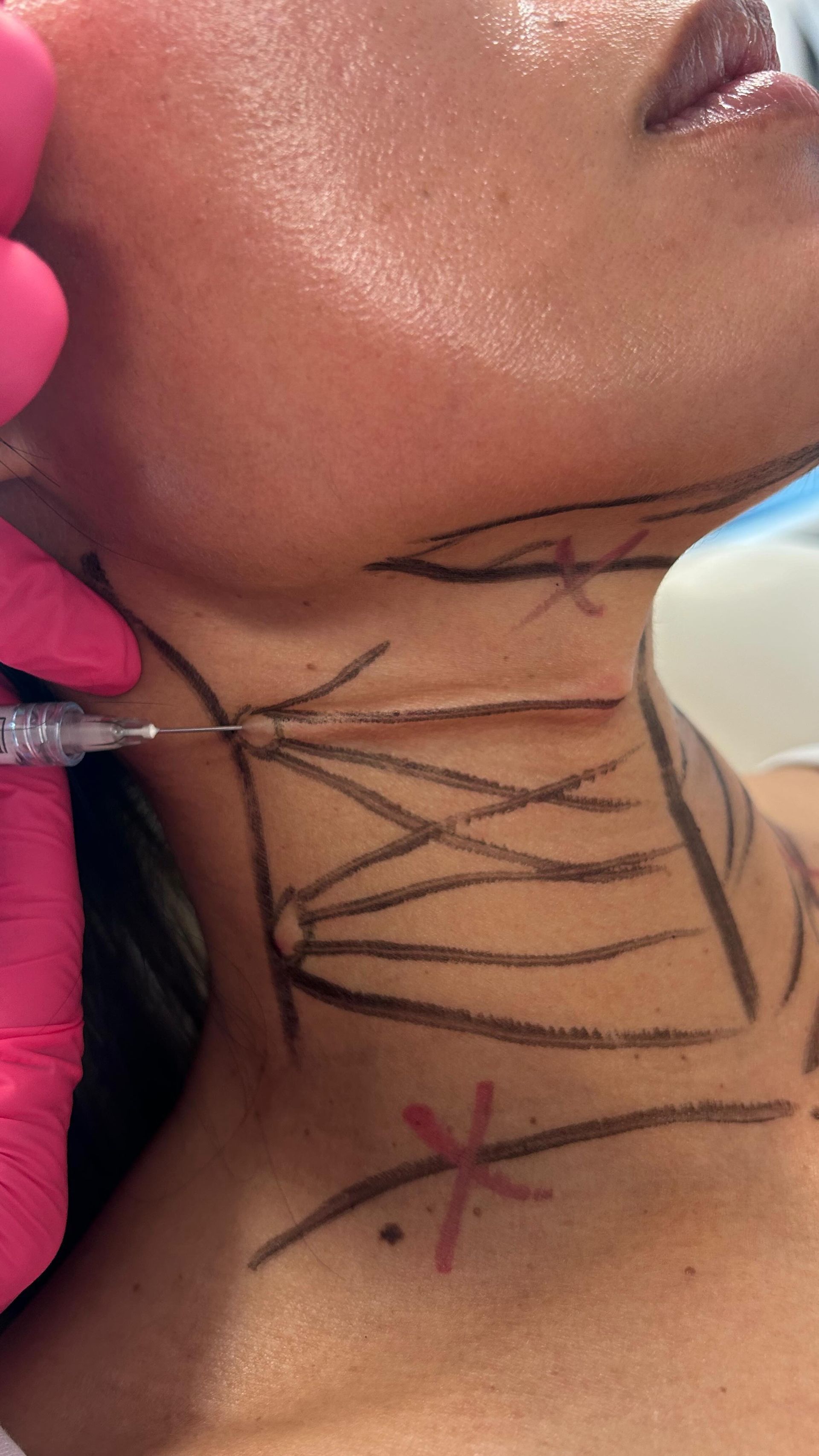 A woman is getting a botox injection in her neck.