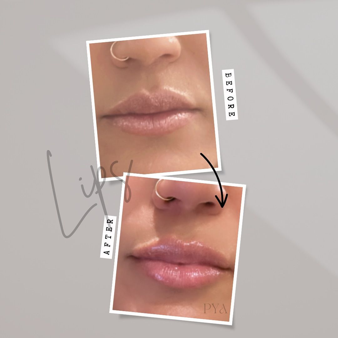 A before and after photo of a woman 's lips and nose