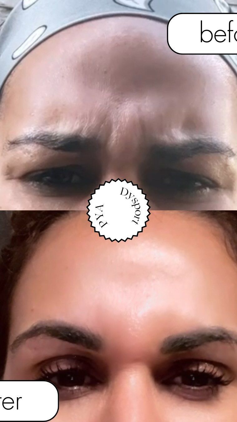 A before and after photo of a woman 's forehead